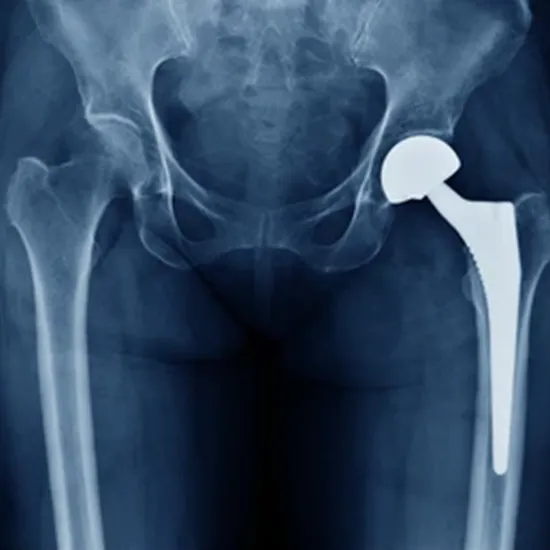 mri screening both hip joint test